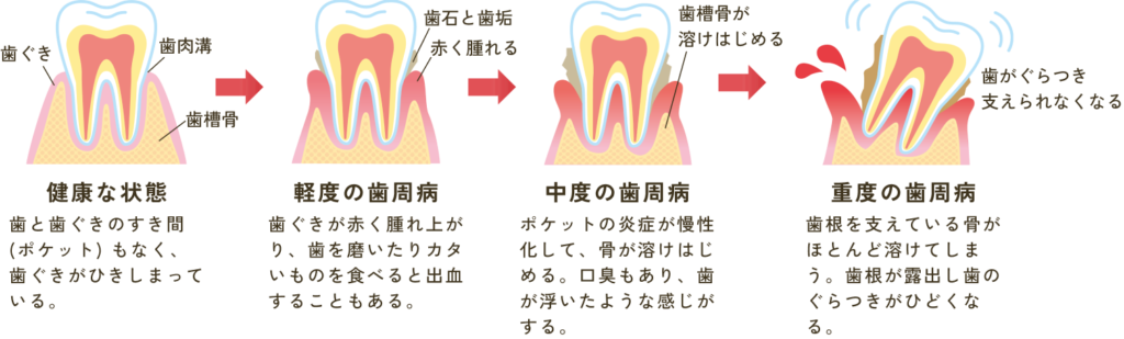 歯周病の症状・影響