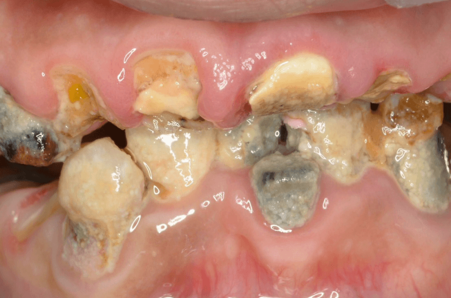 虫歯治療の症例_01