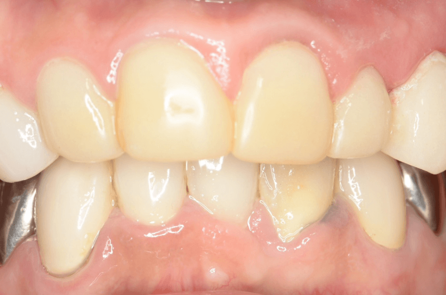 虫歯治療の症例_02