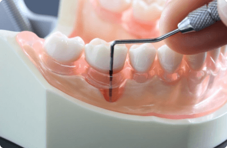 歯周ポケットを測定