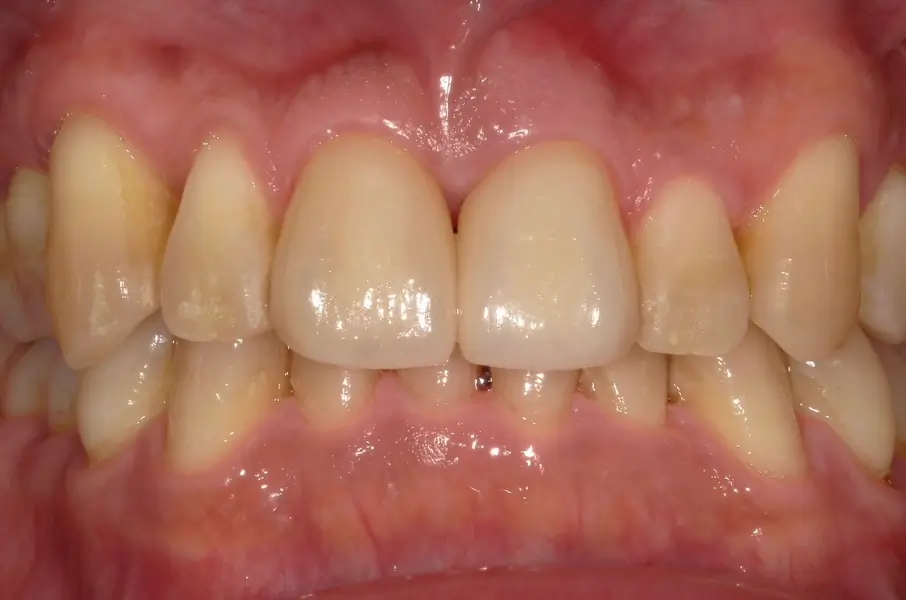 審美歯科治療の症例