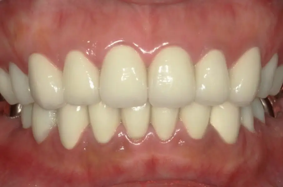 審美歯科治療の症例