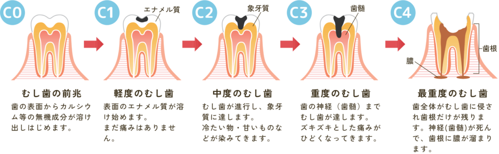 むし歯の症状・影響