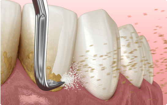 歯周外科治療/スケーリング