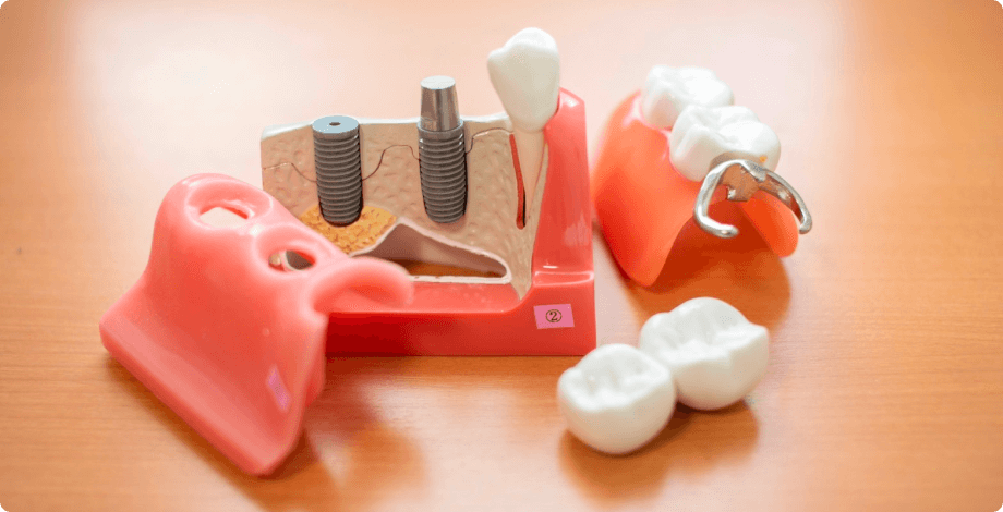 カウンセリング(インプラント相談)