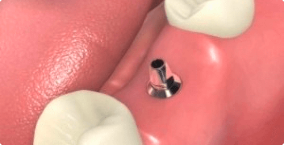 二次オペ アバットメント取付