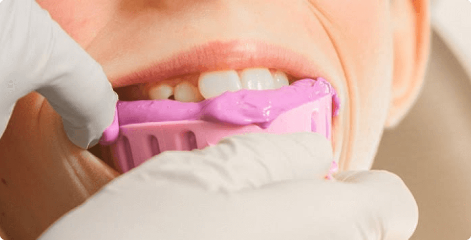 被せる歯の型取り